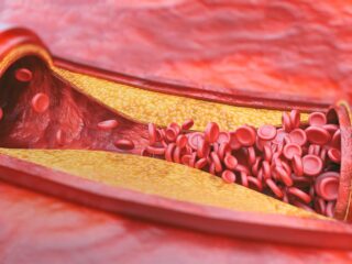 atherosclerose image