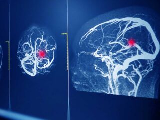anevrisme de cerveau cerebral vasculaire cause et facteurs de risques