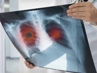 cancer poumon vitamine c e antioxydant