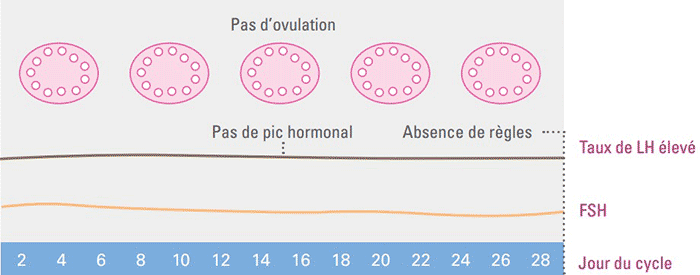 cycle menstruel avec sopk