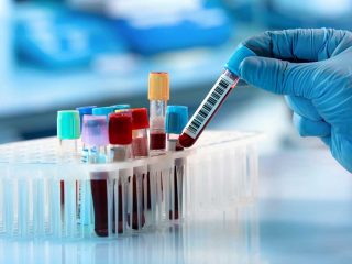 sante metabolique : quels sont les biomarqueurs a surveiller ?