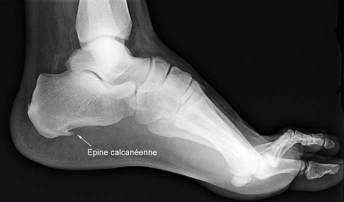 radio pied epine calcaneenne