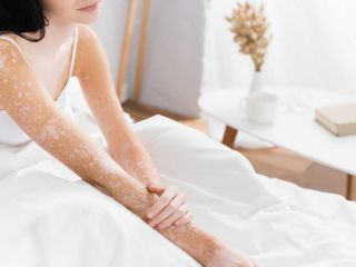 vitiligo taches blanches depigmentation peau visage mains corps