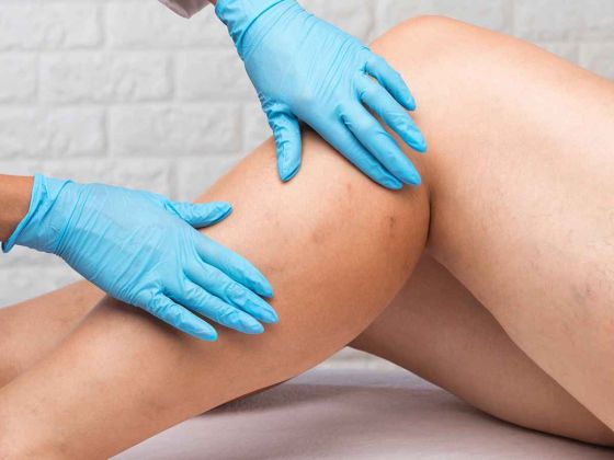 jambes lourdes oedemes varices insuffisance veineuse chronique