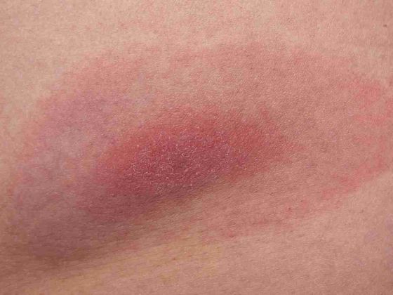 maladie lyme tique infection bacterienne borrelia burgdorferi symptomes erytheme