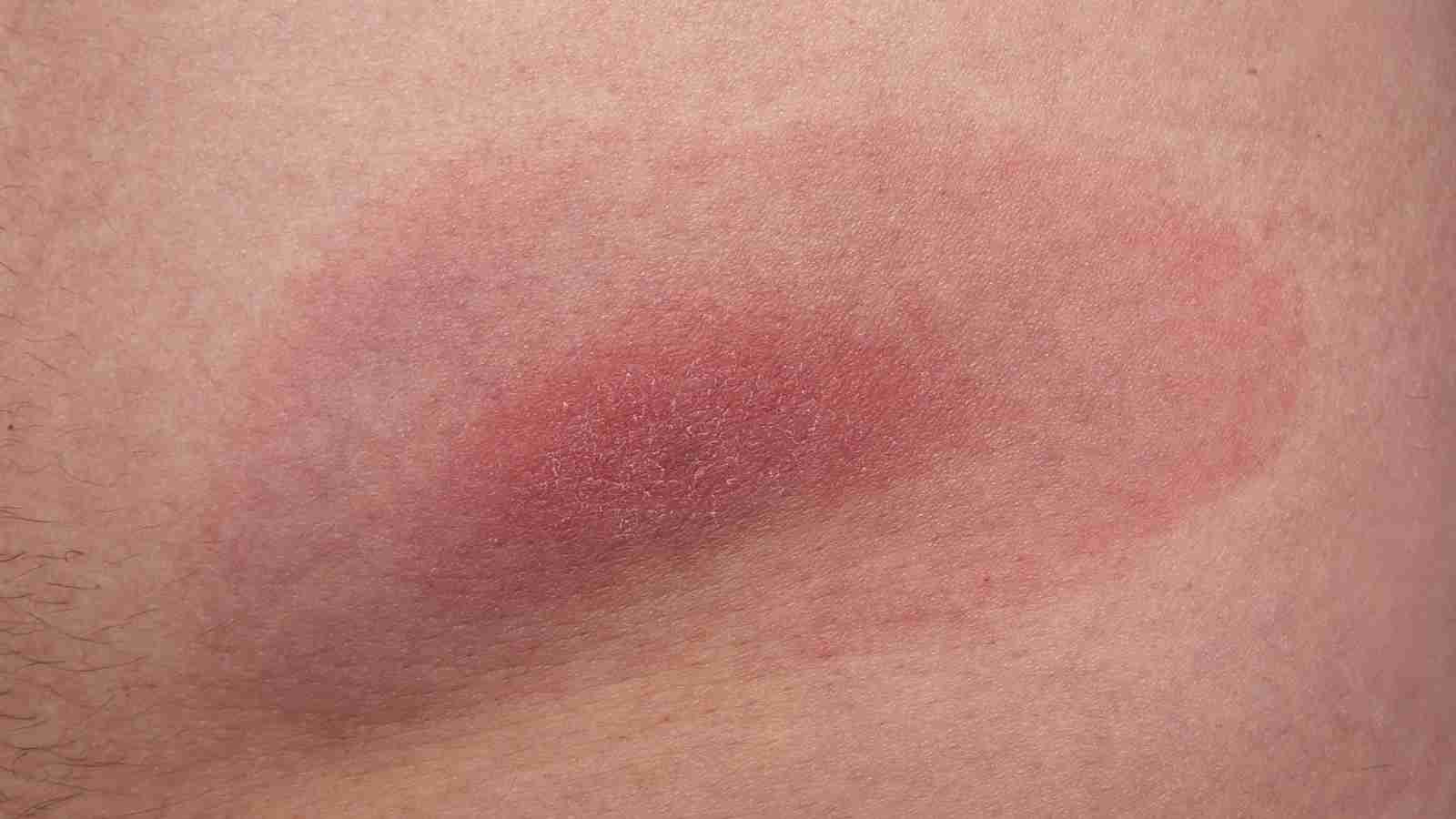 maladie lyme tique infection bacterienne borrelia burgdorferi symptomes erytheme