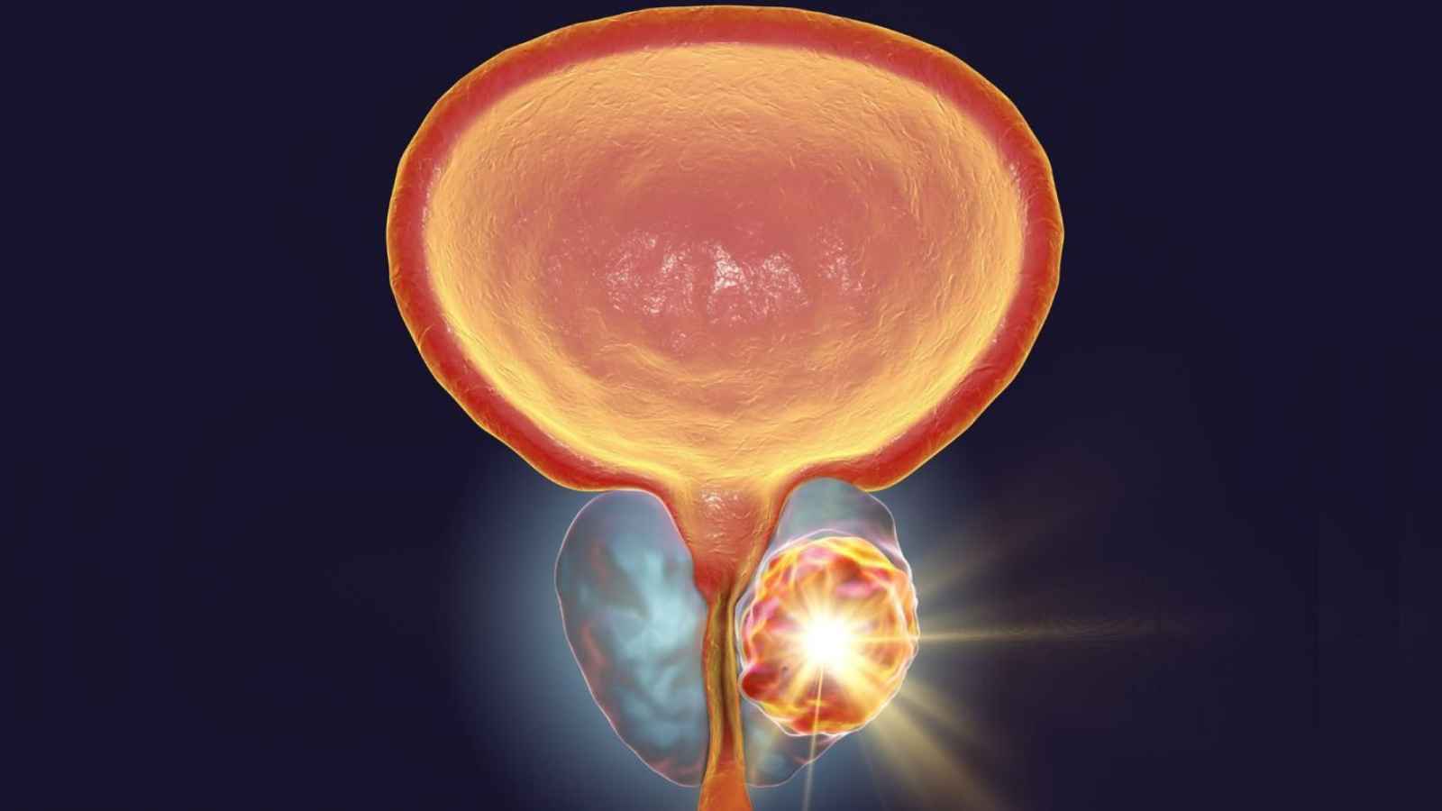 cancer prostate depistage symptomes traitement prevention facteurs risque diagnostic psa