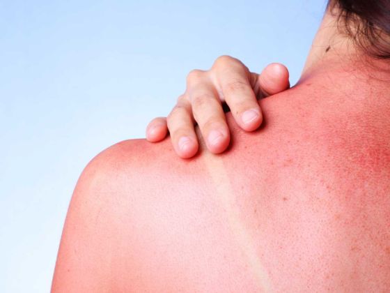 coup de soleil peau rouge douleur uv creme solaire prevention traitement brulure cloques hydratation symptomes exposition